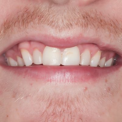 Porcelain Veneers - Smile 3 before